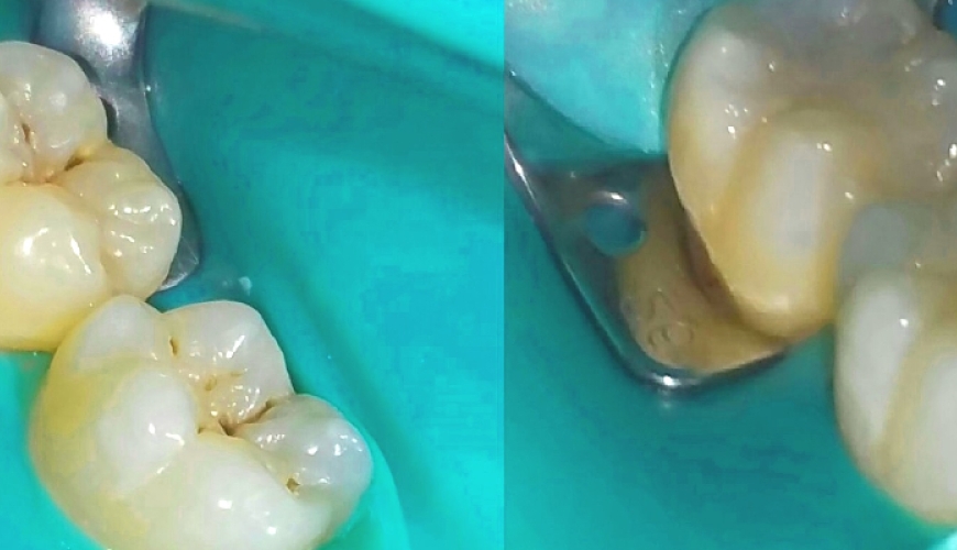 Rubber Dam Restoratif ve Endodontik Tedavilerin Vazgeçilmezi